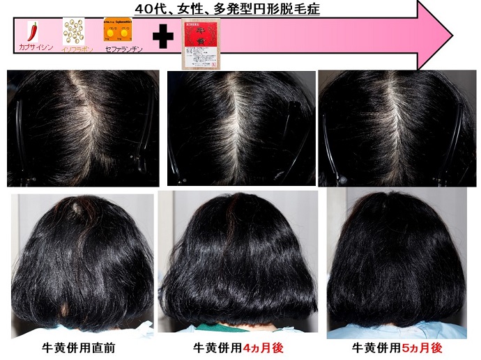 円形脱毛症　病院